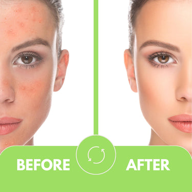 KLARON 2% Salicylic Acid Serum | 30 ml | Reduces Excessive Oil, Acne, Pimples & Blackheads | Dead Skin Cells | Serum for Women & Men